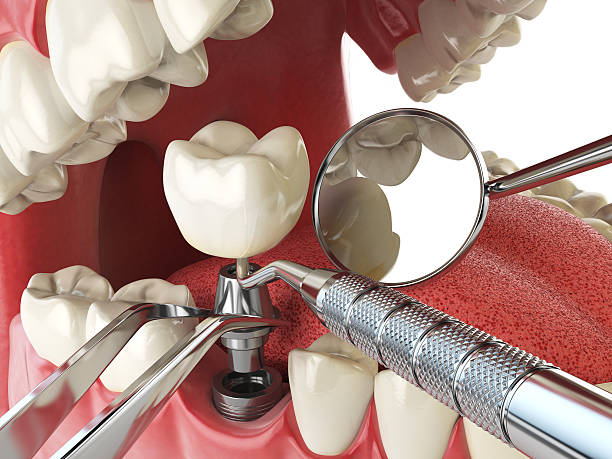 Teeth Whitening in IA